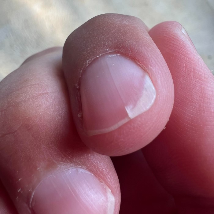 how to fix a vertical split nail
