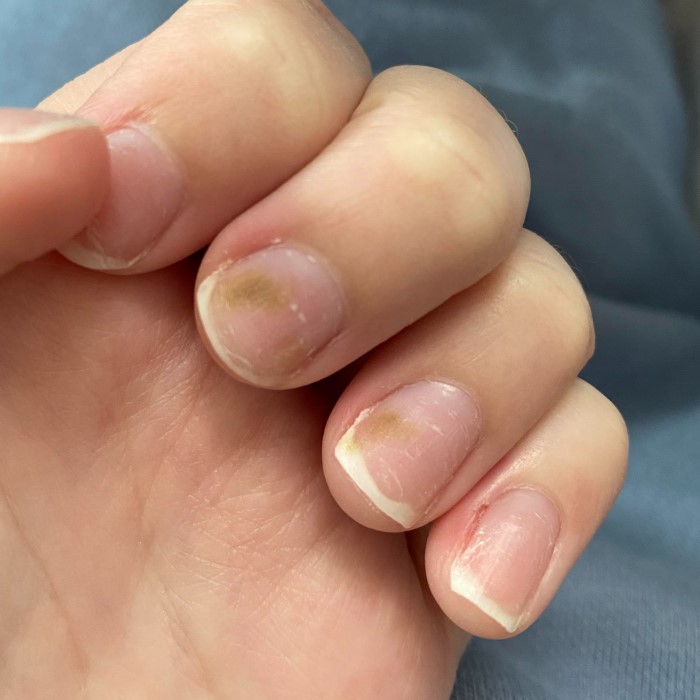 how to get rid of green nail fungus