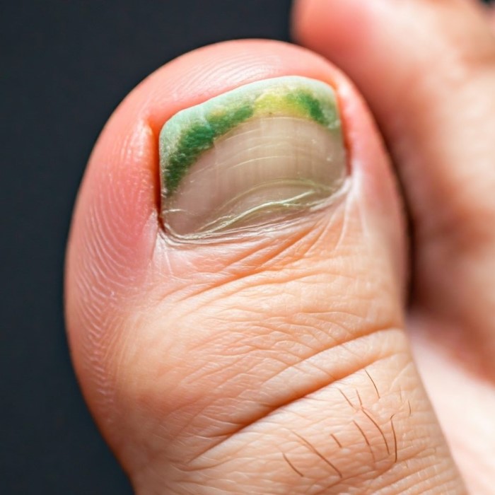 how to get rid of green nail fungus