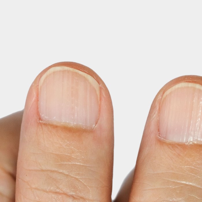 how to fix a vertical split nail