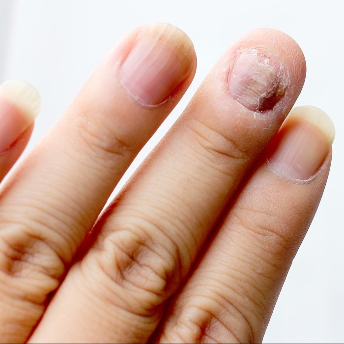 how to get rid of green nail fungus