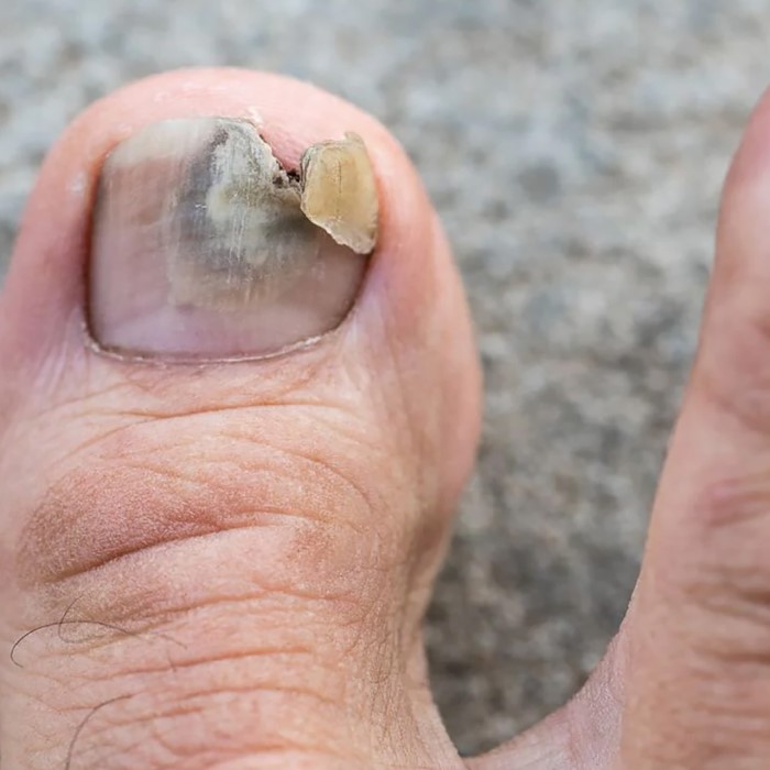 how to get rid of green nail fungus