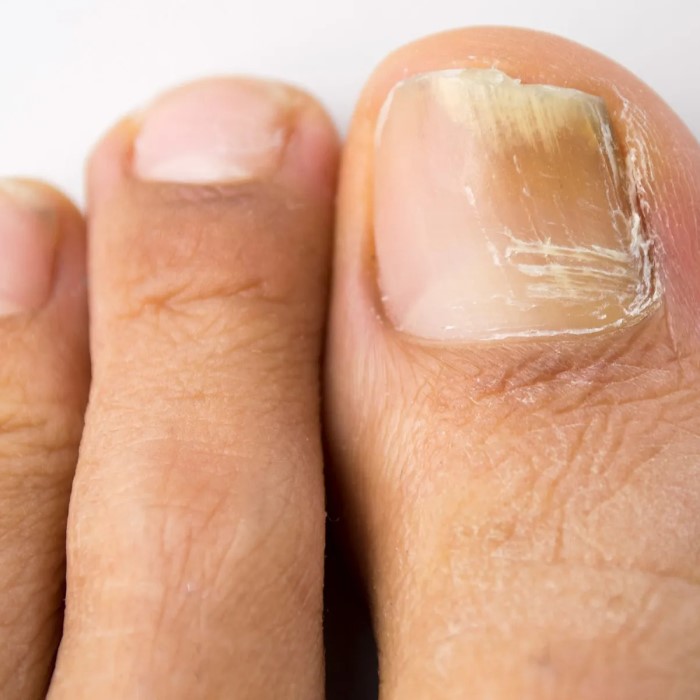how to get rid of green nail fungus
