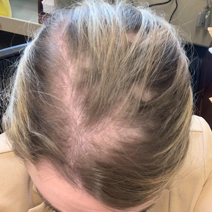 can accutane cause hair loss