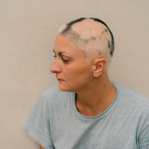 can dehydration cause hair loss