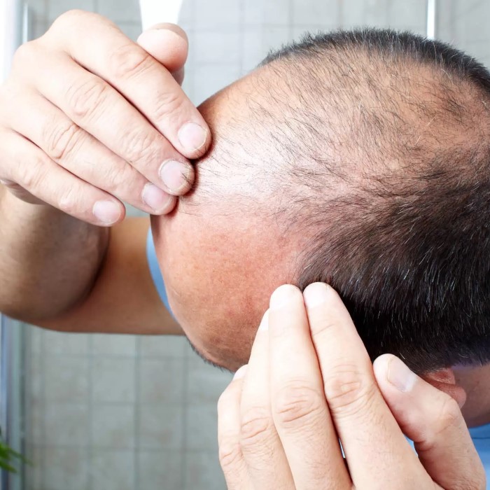 can metformin cause hair loss