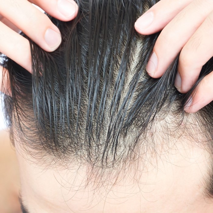 does accutane cause hair loss