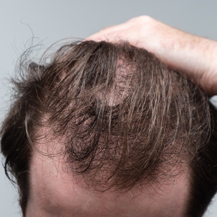 does weight loss cause hair loss