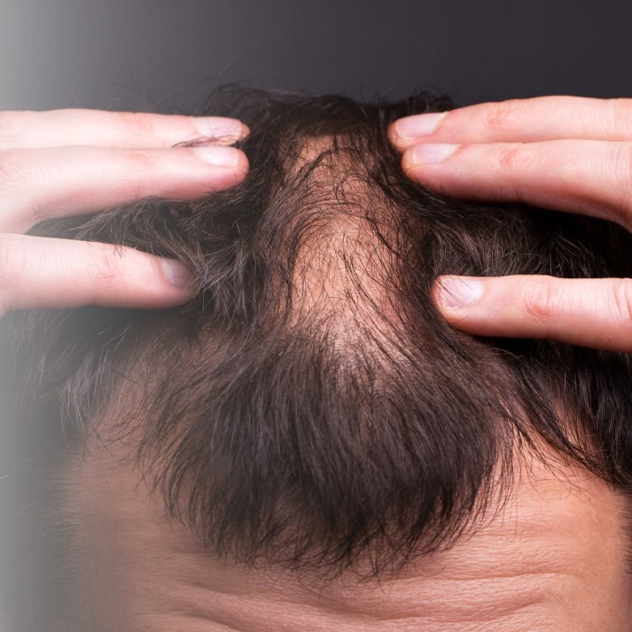 does alcohol cause hair loss