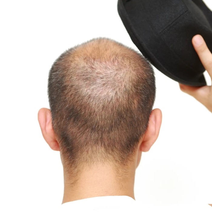 does wearing a hat cause hair loss