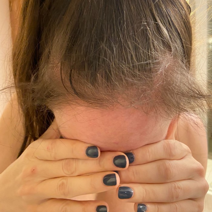 can dry shampoo cause hair loss