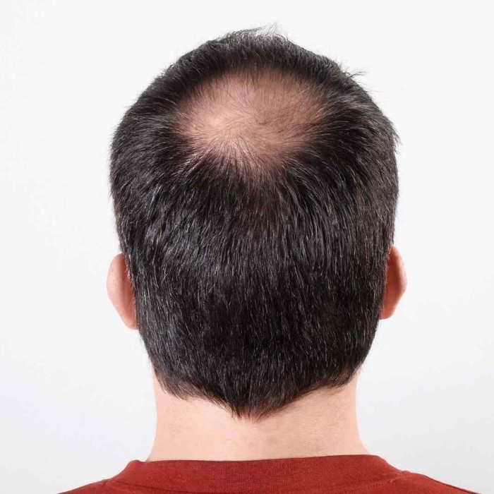 does wearing a hat cause hair loss