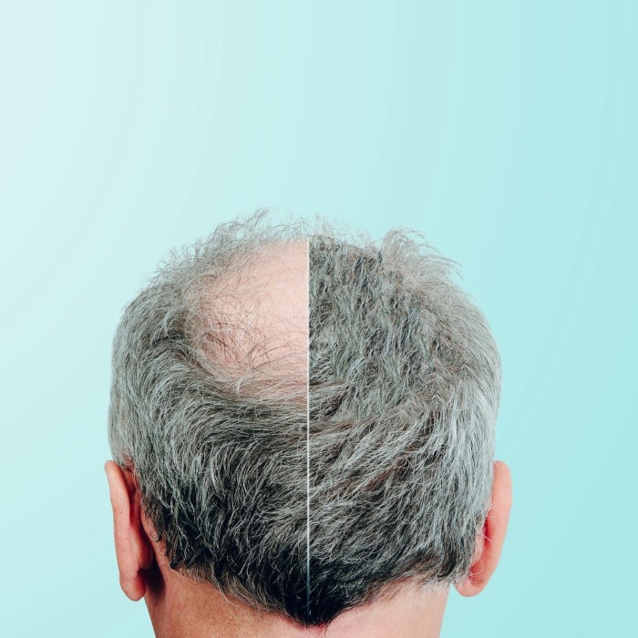 can metformin cause hair loss