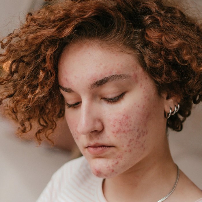 does accutane cause hair loss