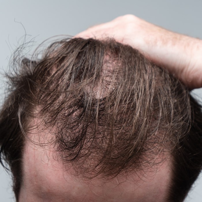 does mounjaro cause hair loss