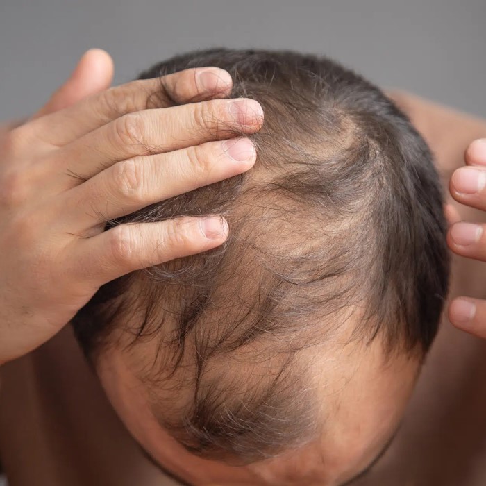 does creatine cause hair loss