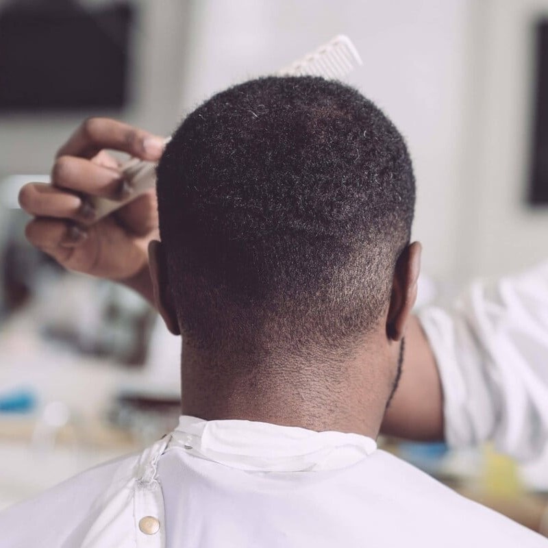 does radiation cause hair loss