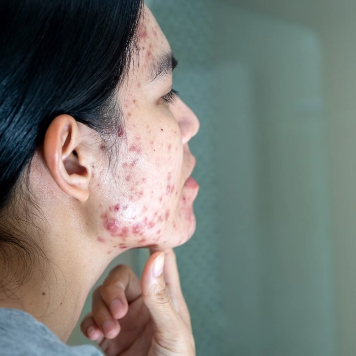 can accutane cause hair loss