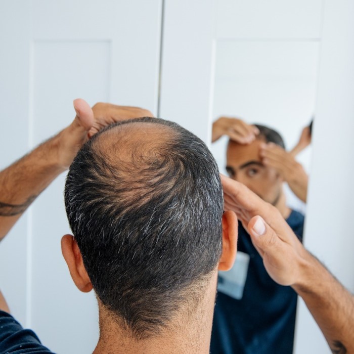 does mounjaro cause hair loss