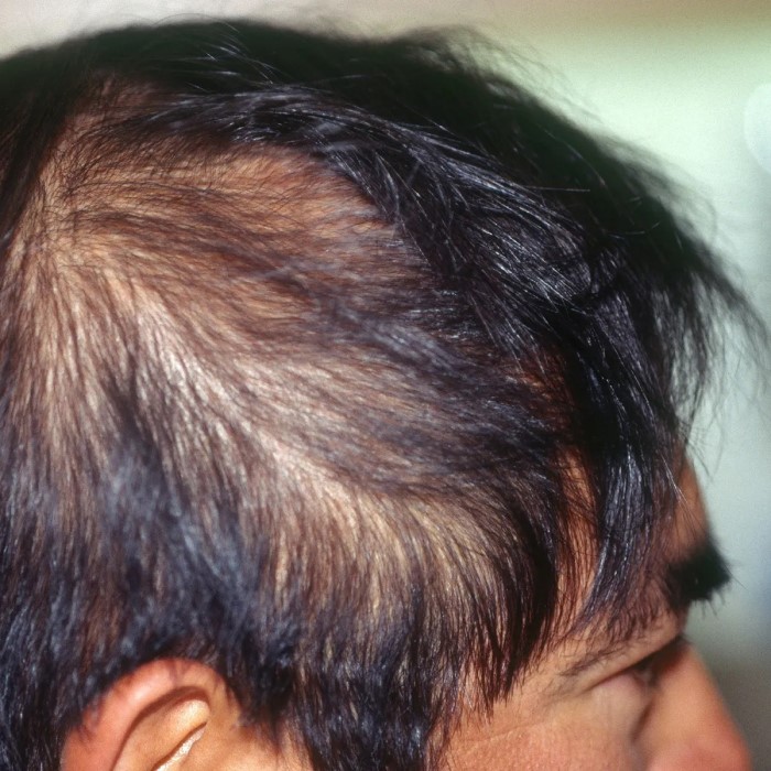 does high cortisol cause hair loss
