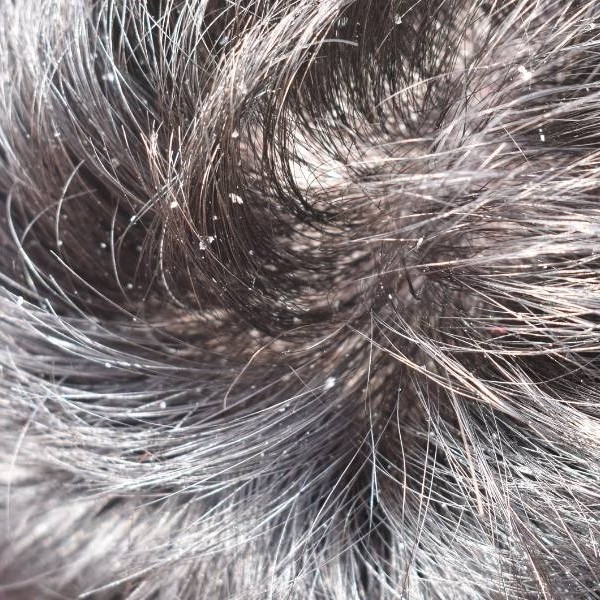 does diabetes cause hair loss