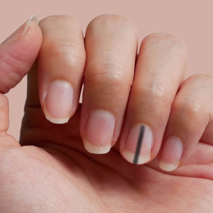 why is there a black line on my nail
