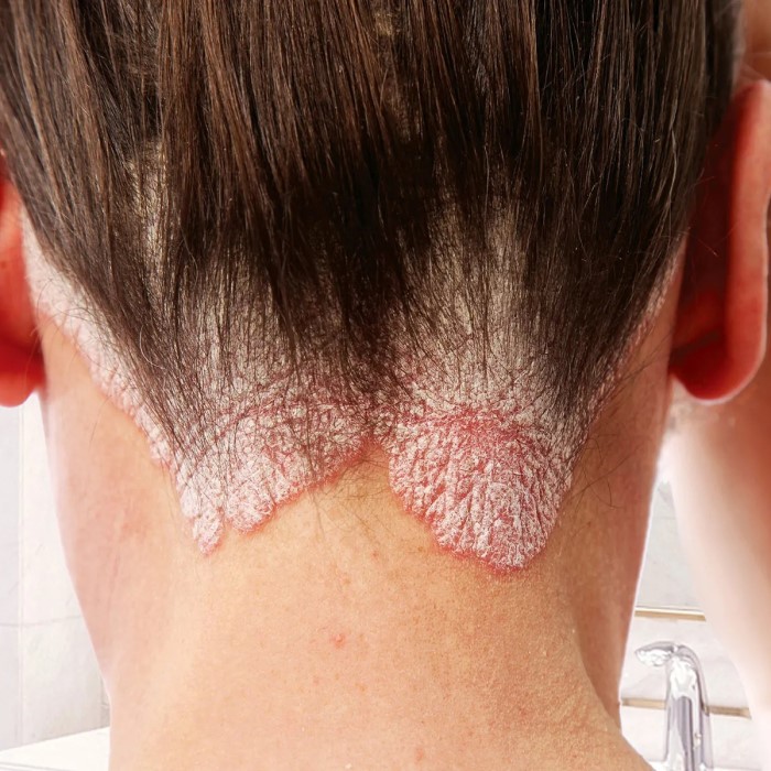 does scalp psoriasis cause hair loss