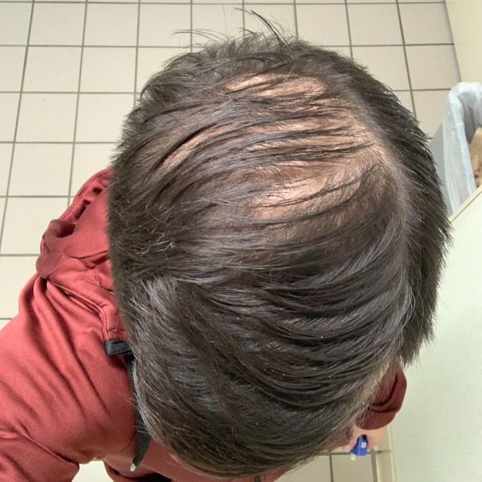 does wearing a beanie cause hair loss