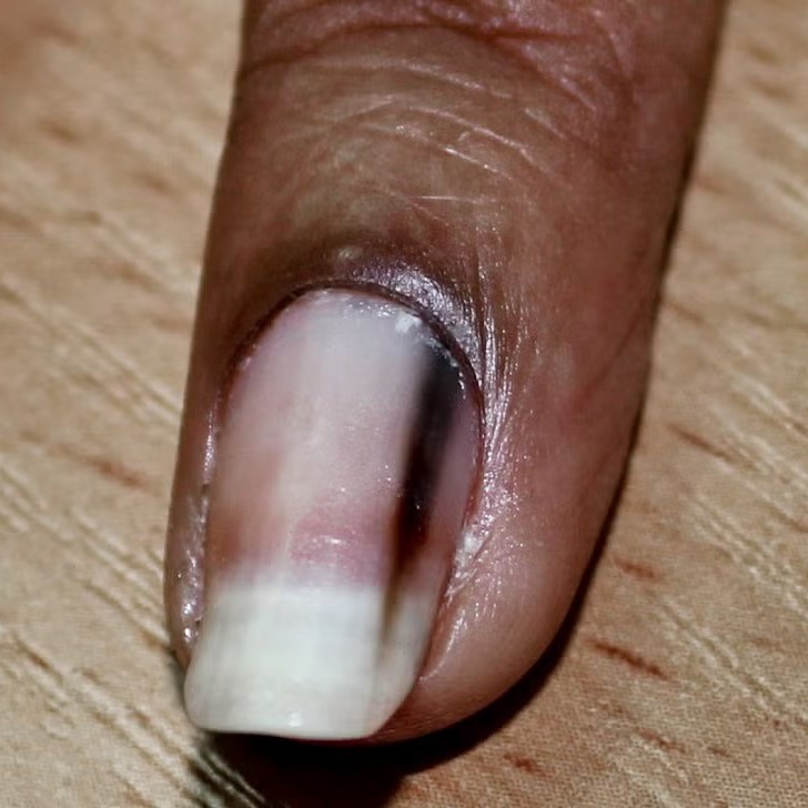 why is there a black line on my nail