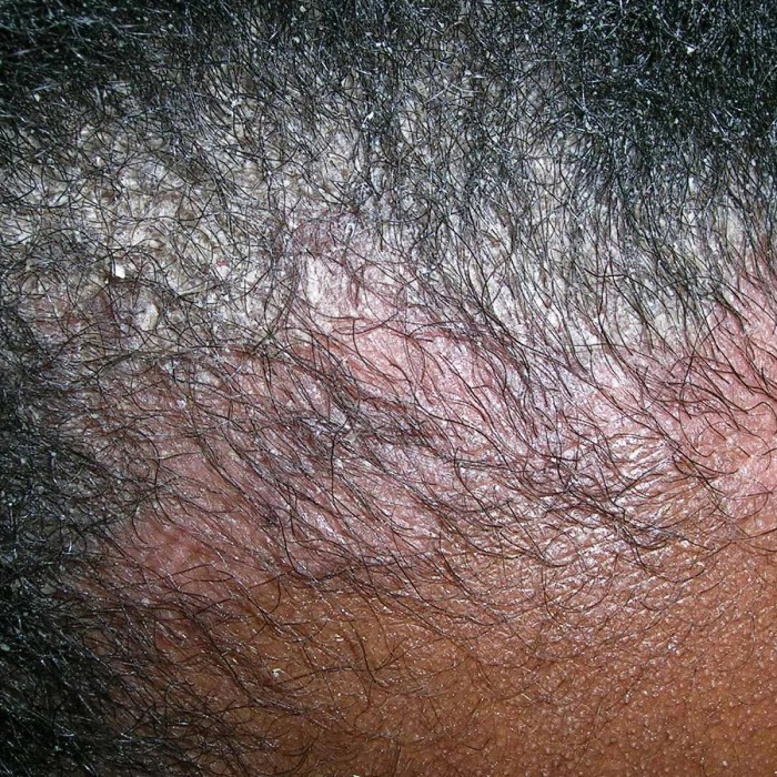 does scalp psoriasis cause hair loss