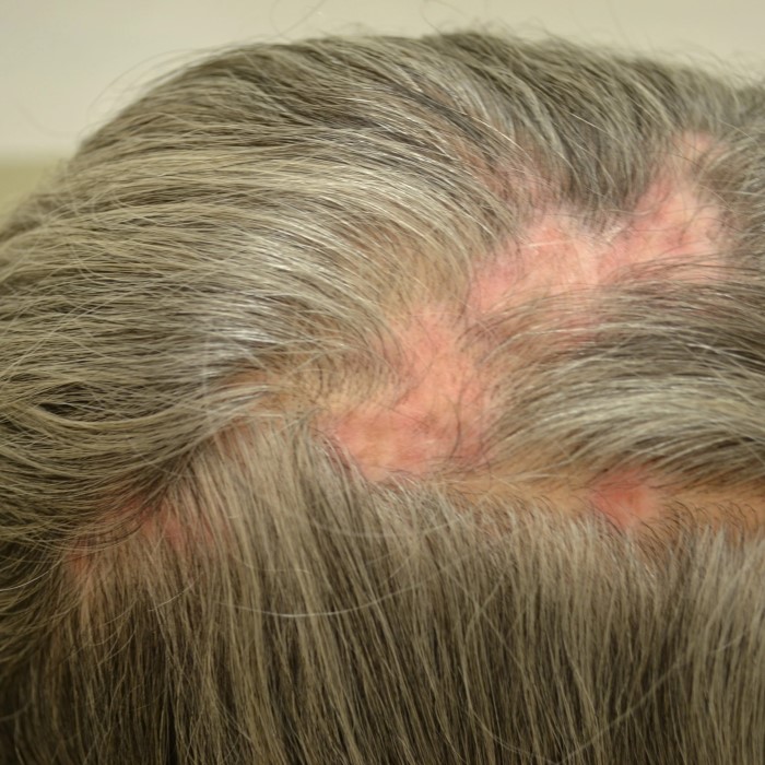 does lupus cause hair loss