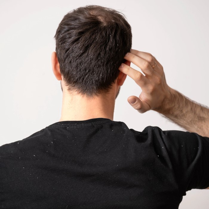 can wellbutrin cause hair loss