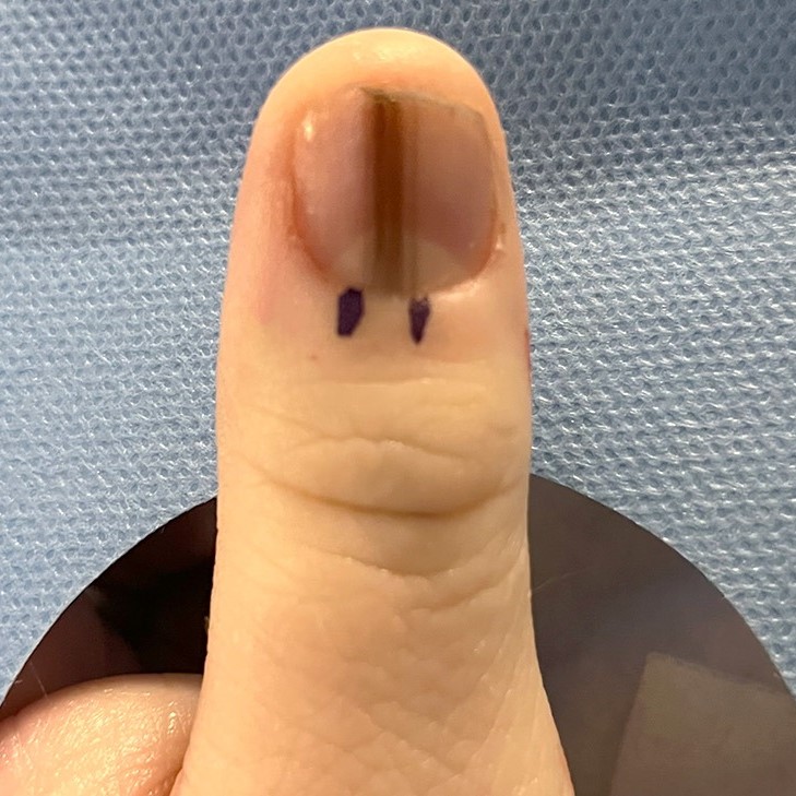 why is there a black line on my nail