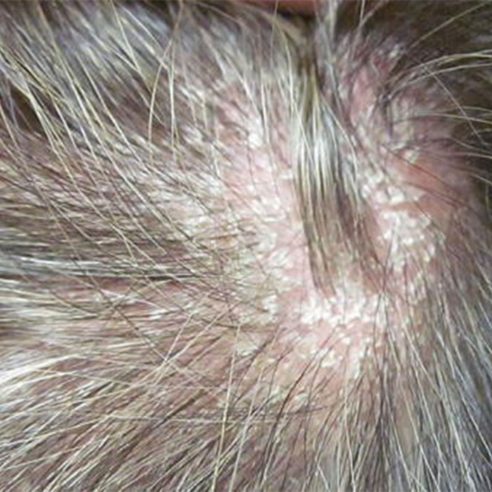 does scalp psoriasis cause hair loss