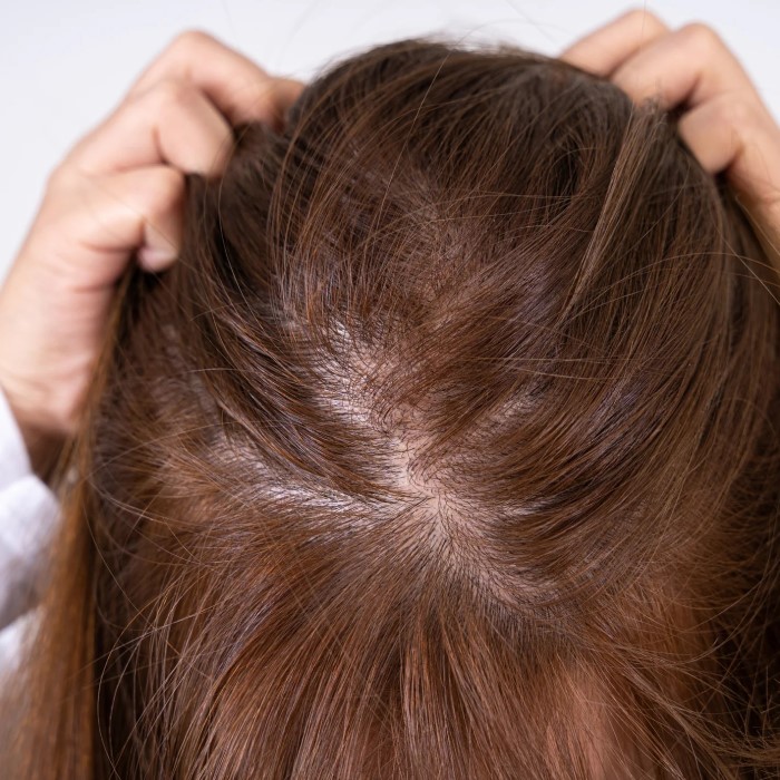 does dry scalp cause hair loss