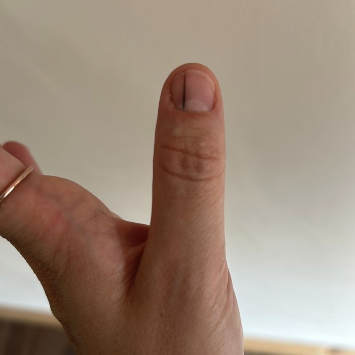 why is there a black line on my nail
