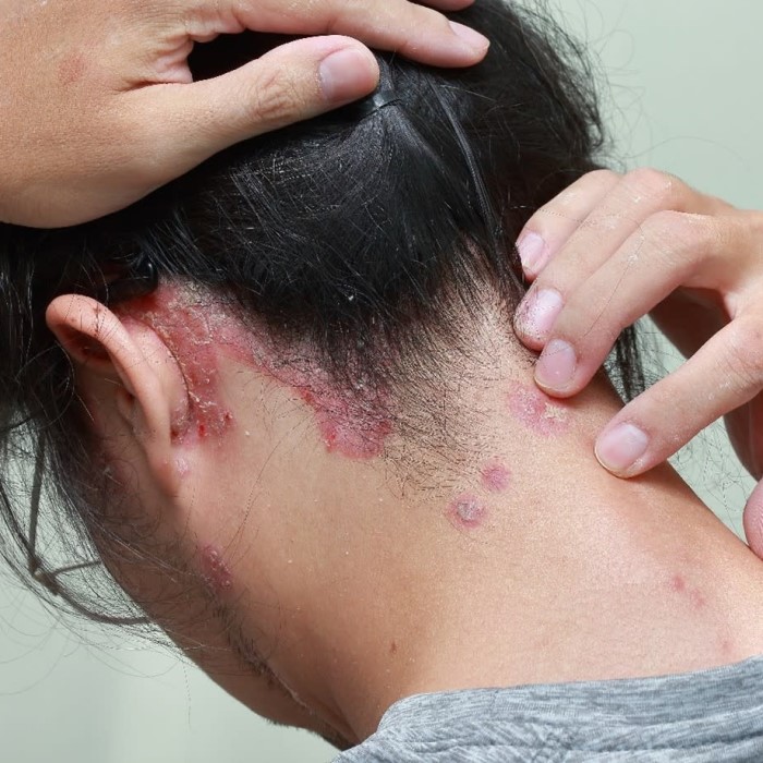 does scalp psoriasis cause hair loss