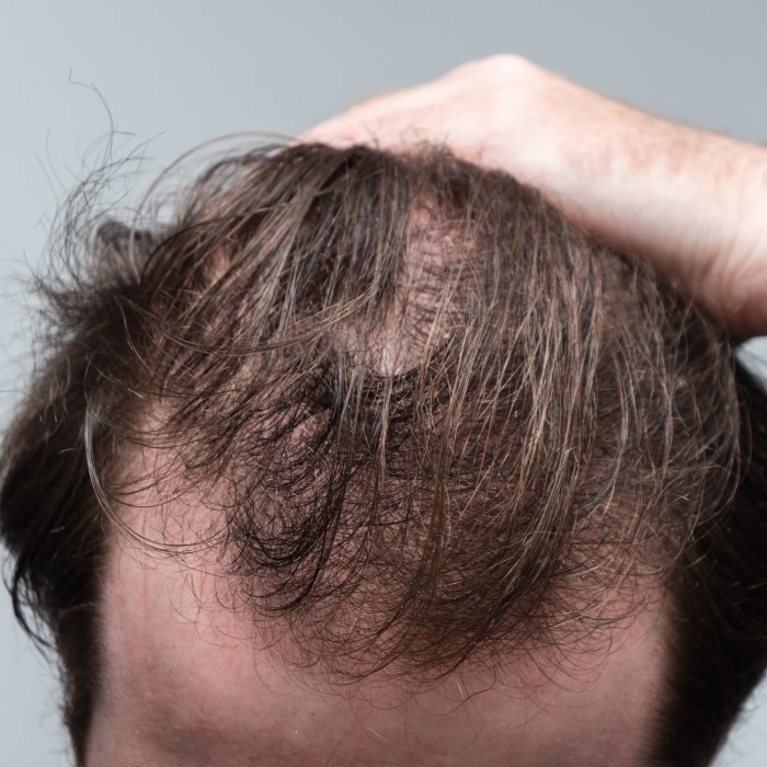 does smoking weed cause hair loss
