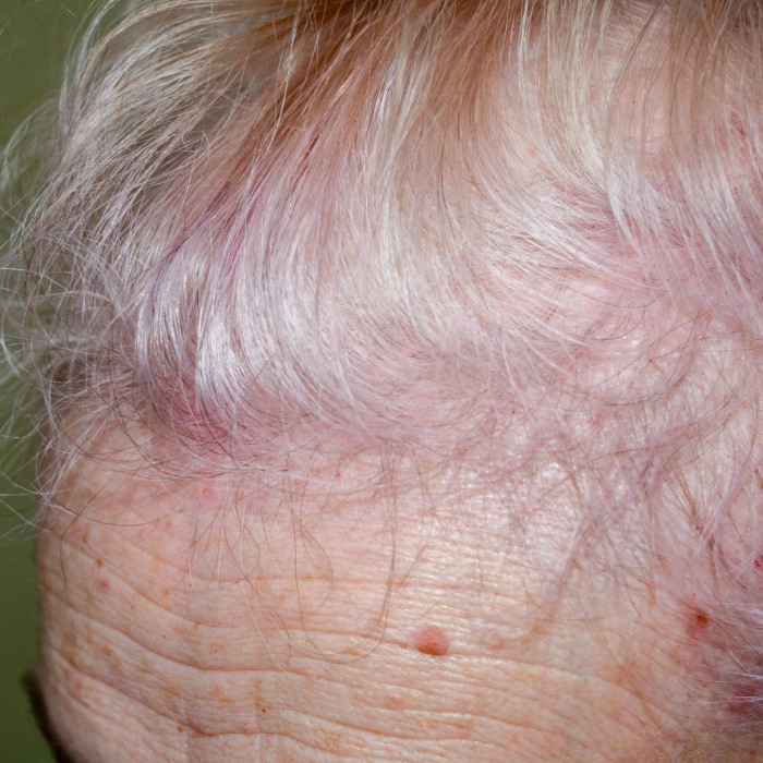 does lupus cause hair loss