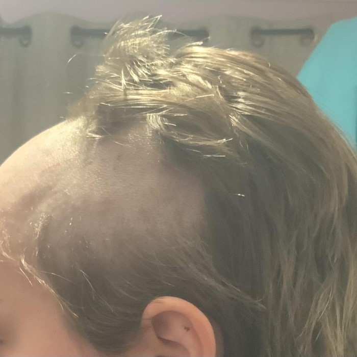 does lexapro cause hair loss