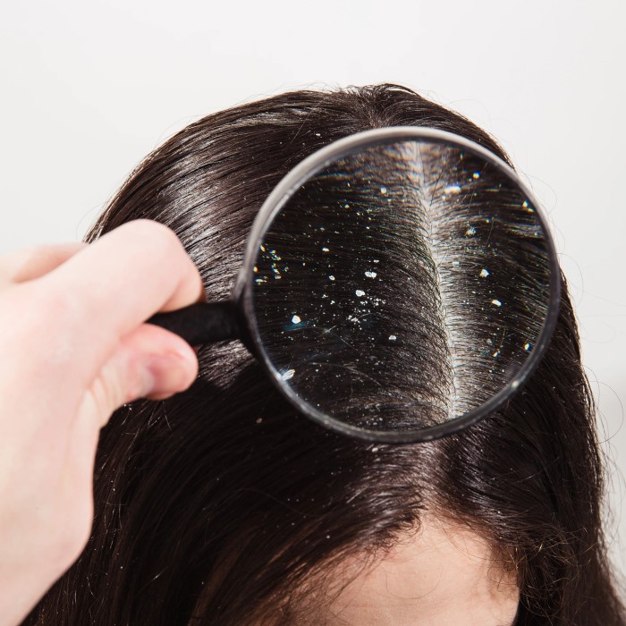 does dry scalp cause hair loss