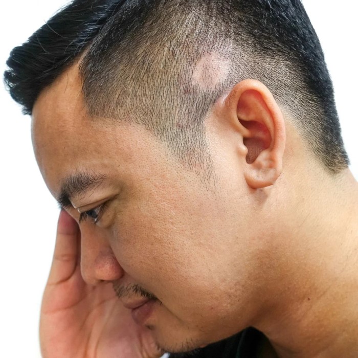 does lupus cause hair loss