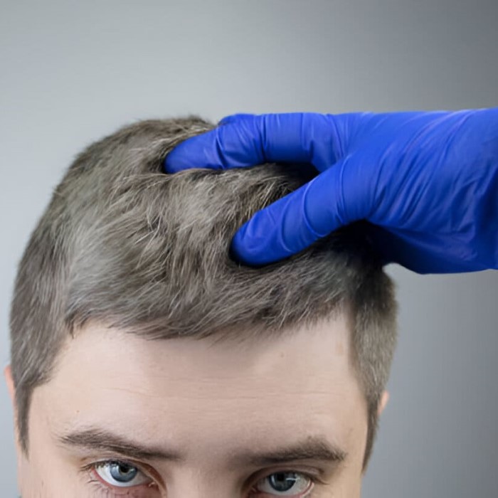 does hair dye cause hair loss