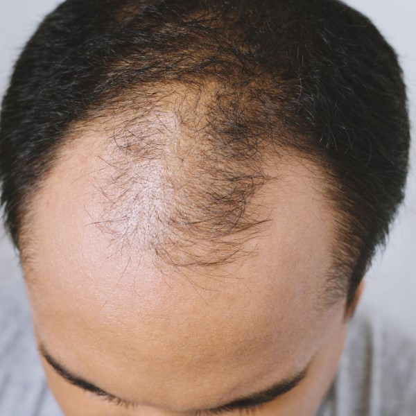 does amlodipine cause hair loss