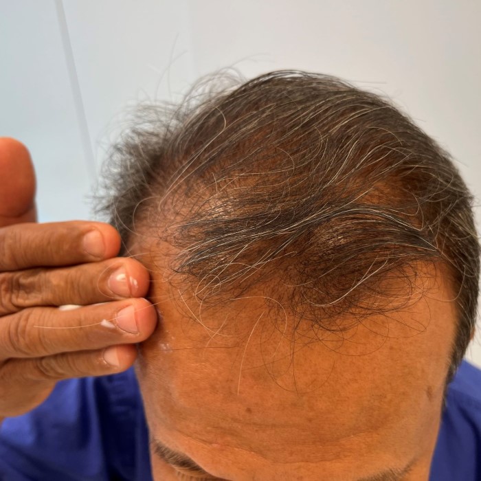 can cancer cause hair loss