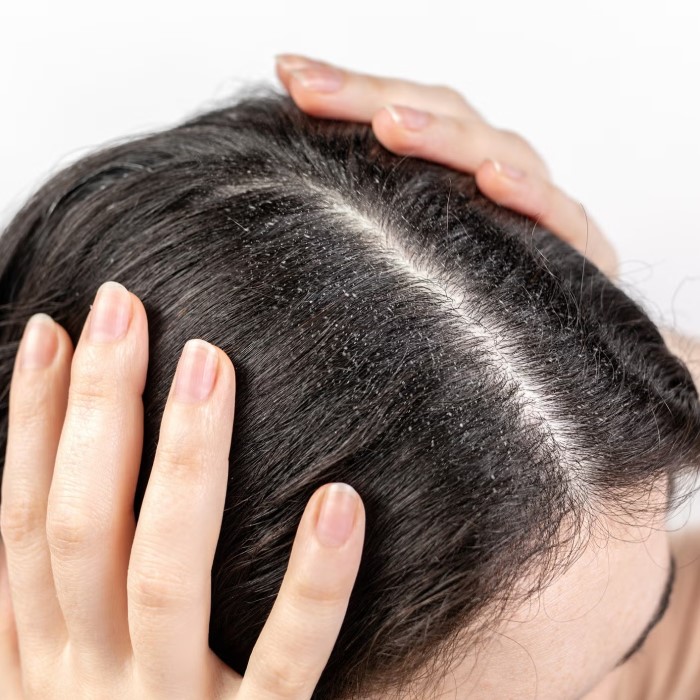 does dry scalp cause hair loss