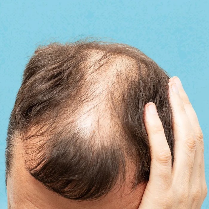 does diabetes cause hair loss