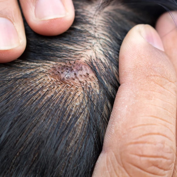 does dry scalp cause hair loss