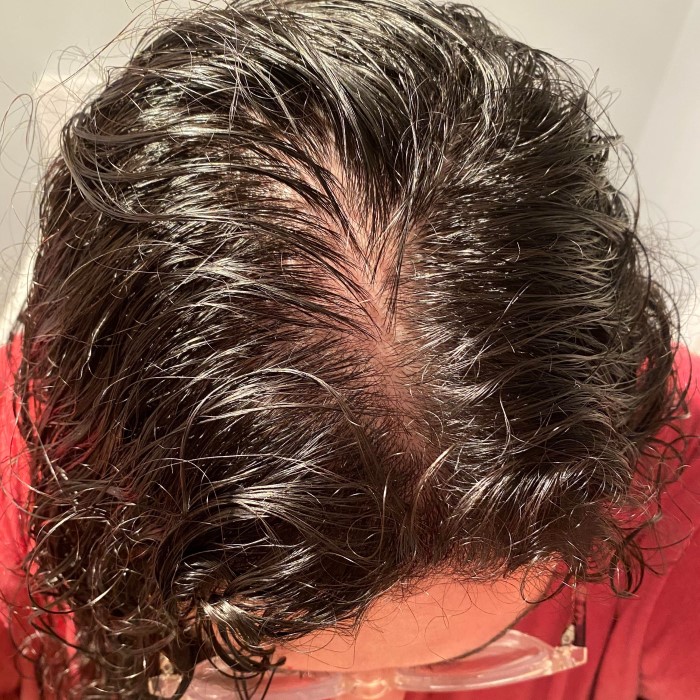 does b12 deficiency cause hair loss