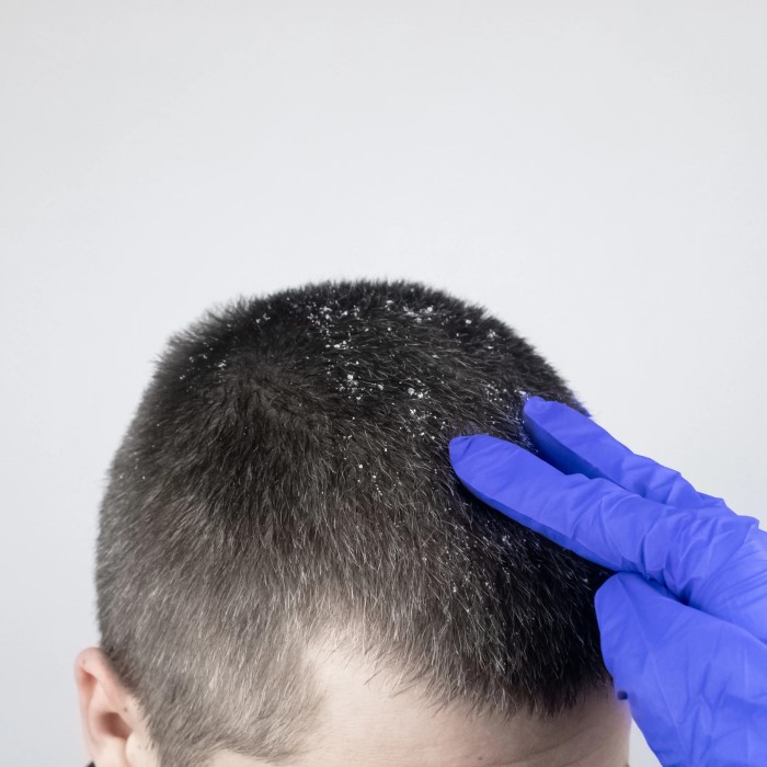 does dry scalp cause hair loss